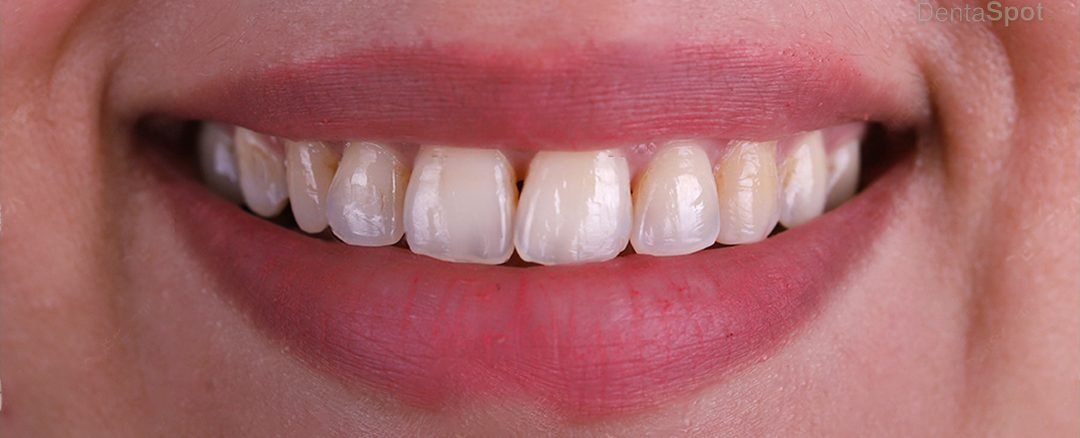 Before treatment