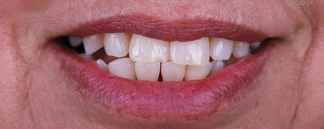 Before treatment
