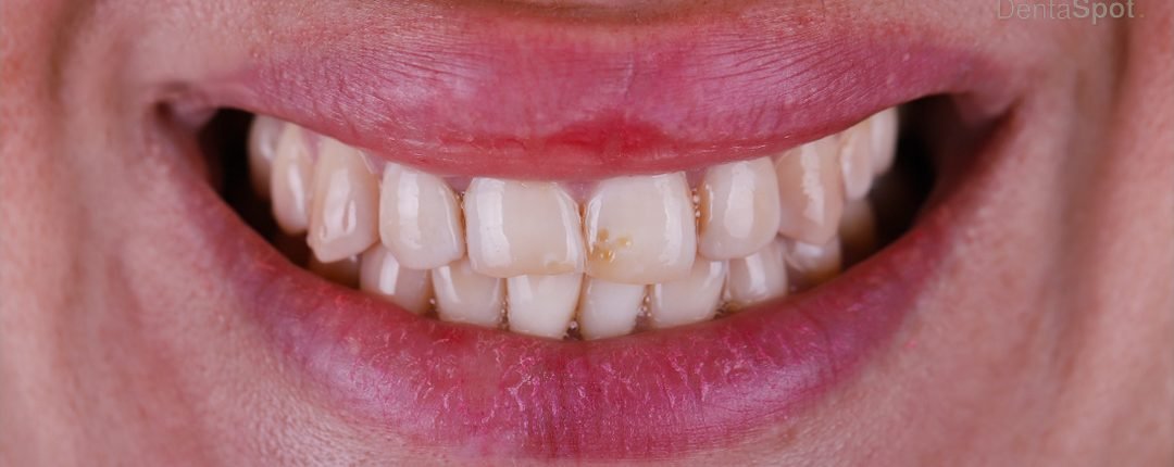 Before treatment